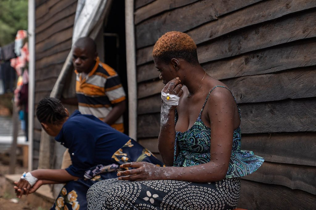 African infectious disease expert concerned about mutated mpox strain